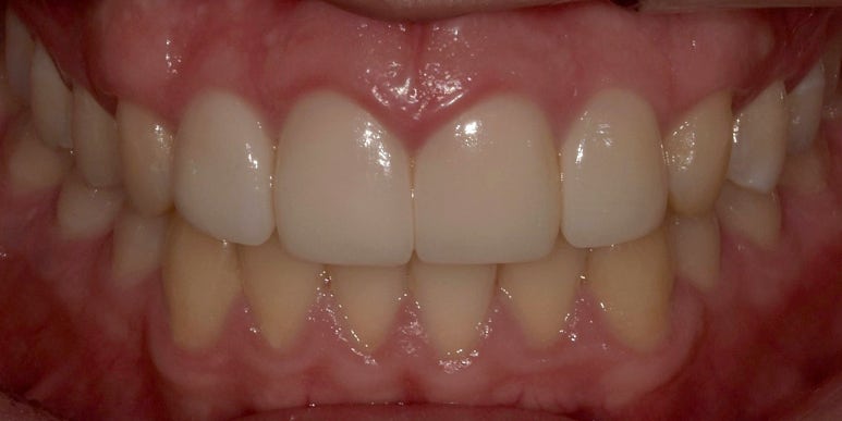 남자라미네이트, 최신 치료사례와 비용까지 전부 공개합니다. 관련 이미지 10