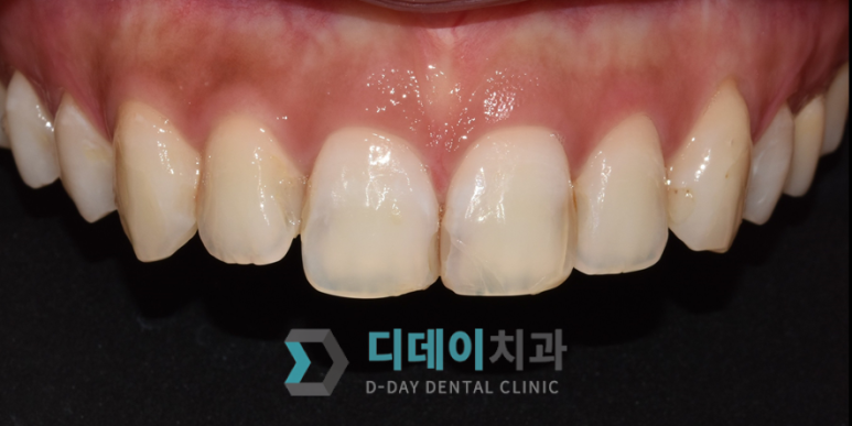 앞니크라운빠짐, 탈락한 경우 재부착 가능할까요? 관련 이미지 4