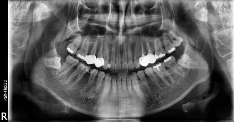 발치즉시임플란트, 아무나 다 되는건 아닙니다. 관련 이미지 3