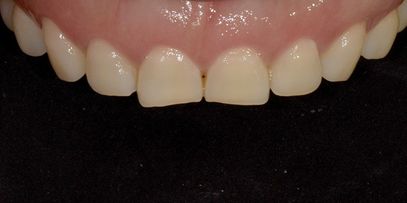 잇몸성형유지기간? 치과의사가 직접 알려드립니다. 관련 이미지 6