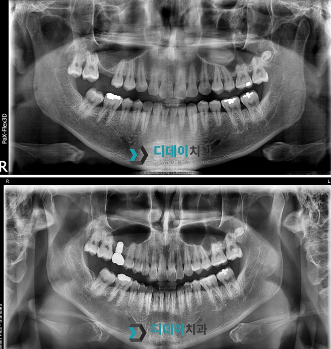 도곡동치과, 임플란트 잘하는 곳 못 찾는 이유 딱 1가지입니다 관련 이미지 5
