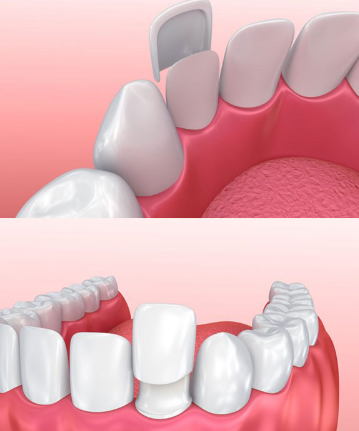 라미네이트 시술 전, 알아야할 3가지 꿀팁 관련 이미지 4