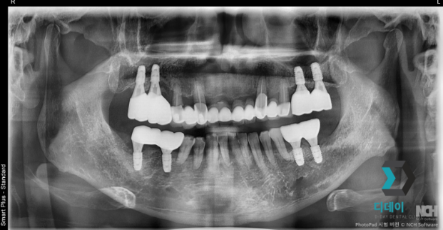 신논현역임플란트, 수술 경험 많은 의사가 알려주는 2가지 기준 관련 이미지 5