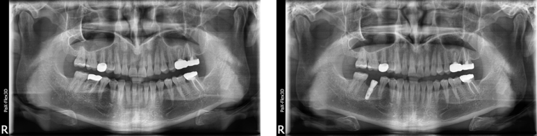 임플란트기간과 내원횟수는 얼마나 될까? 관련 이미지 9
