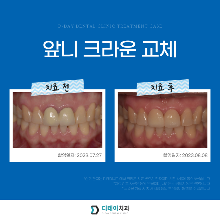 앞니크라운, 라미네이트 같이 하면 티날까? 사진으로 증명합니다. 관련 이미지 6