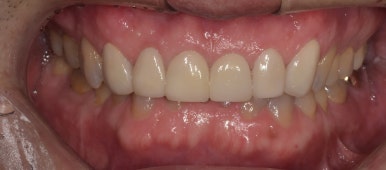 라미네이트후기, 닳아있고 변색된 치아 치료한 최신사례 관련 이미지 4