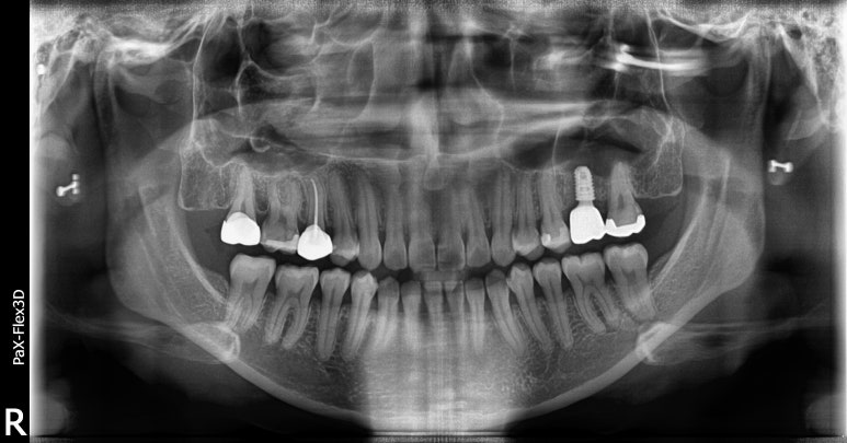 20대임플란트 수명? 평생 못쓸수도 있습니다. 관련 이미지 6