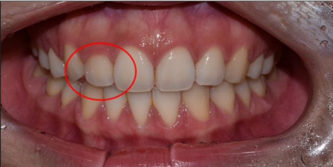 작은이빨, 왜소치? 치아 크기를 키우고 싶은 분만 <필독> 관련 이미지 13