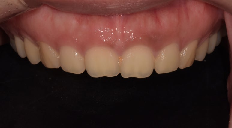 법랑질성형, 잇몸성형, 치아미백까지! 디데이치과 심미치료 총집합 치료사례 관련 이미지 3