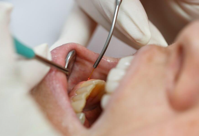 치은성형술, 잇몸이 너무 많이 보여서 웃기 싫었다면 의사 작성 관련 이미지 6