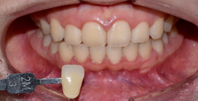 승무원 치아미백, 그 비결이 궁금하다면? 관련 이미지 3