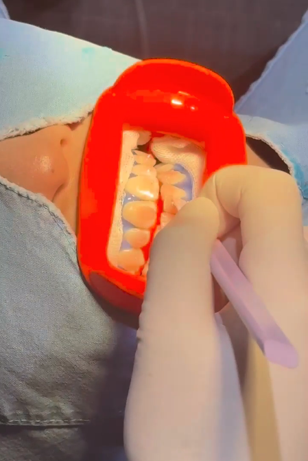 치아미백 라미네이트 잘하는 곳 찾는 2가지 기준 관련 이미지 11