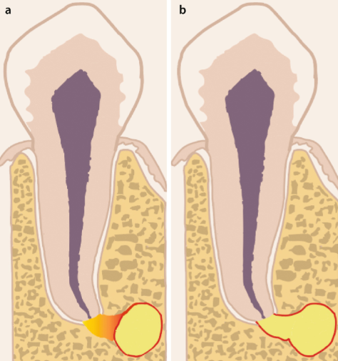 치근낭적출술,치료 시기를 놓치면 생기는 2가지 문제 관련 이미지 4