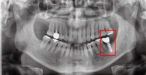 임플란트후붓기? 걱정하시던 환자분 치료 과정 관련 이미지 4