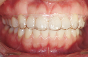 강남역치아교정, 지금 시작하지않으면 비용이 더 들 수 있습니다 관련 이미지 2