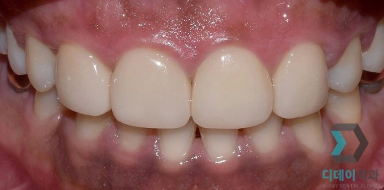 잇몸이까매요... 잇몸착색 치료방법, 사례, 비용 대공개 관련 이미지 7