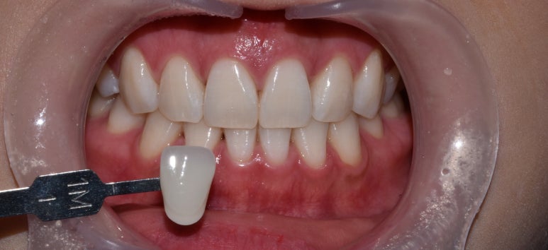 누렁니치아미백, 치료 사례로 보여드리는 개선 효과 관련 이미지 10