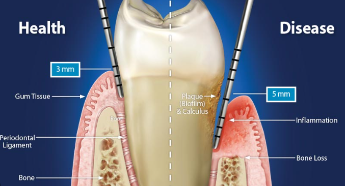 치은박리소파술 필요한 상태? 의사가 알려주는 판단 기준 2가지 관련 이미지 3
