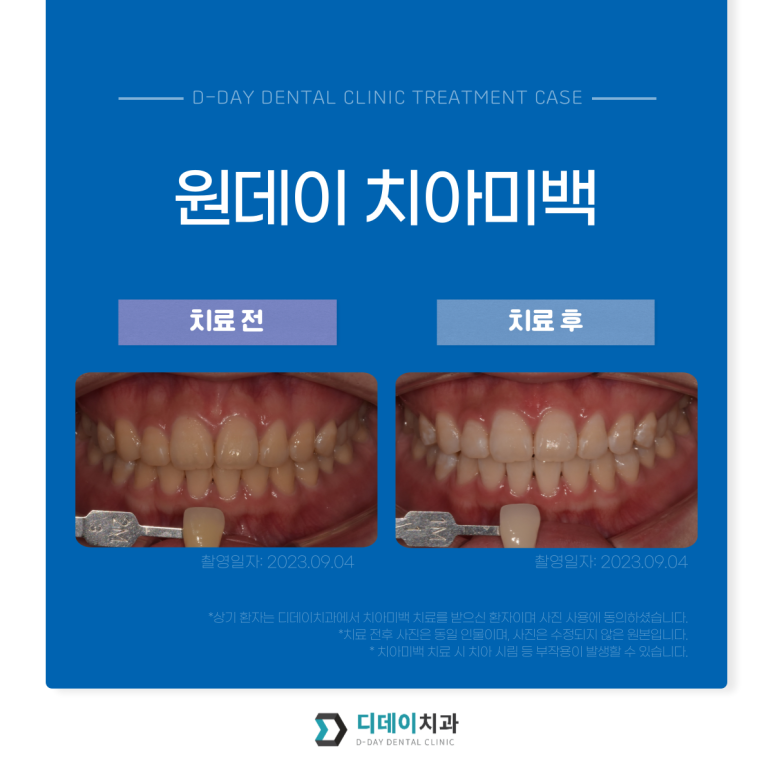 웨딩촬영치아미백? 자신있게, 환하게 웃을 수 있는 꿀팁 관련 이미지 9