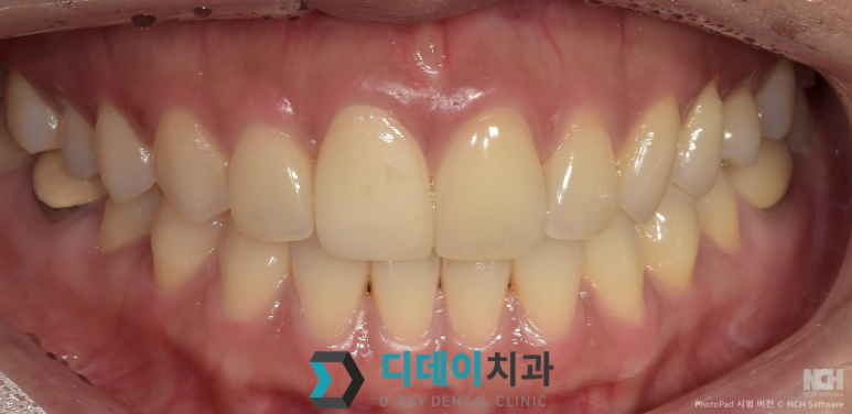 라미네이트 재시술,의사가 직접 설명합니다 관련 이미지 3