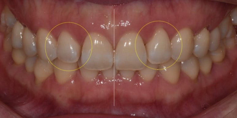 교정후라미네이트? 실제 치료 후기 궁금하신 분만 관련 이미지 6
