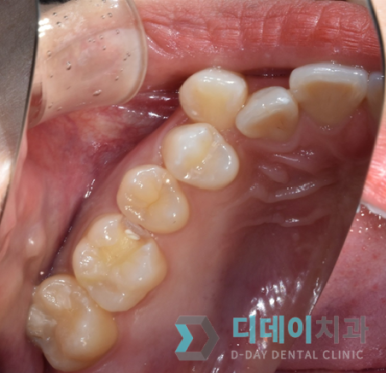 어금니충치치료비용, 병원마다 차이나는 진짜 이유 2가지 관련 이미지 8