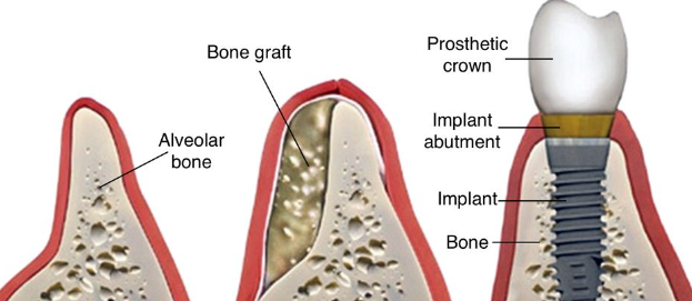 치조골 증대술 , 베테랑들도 어려워하는 이유 관련 이미지 3