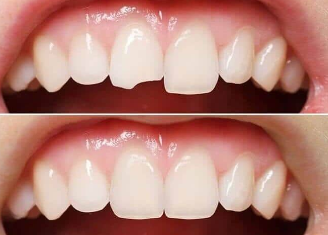 대치동 레진과 인레이 치료 어떤 경우에 사용할까 관련 이미지 5