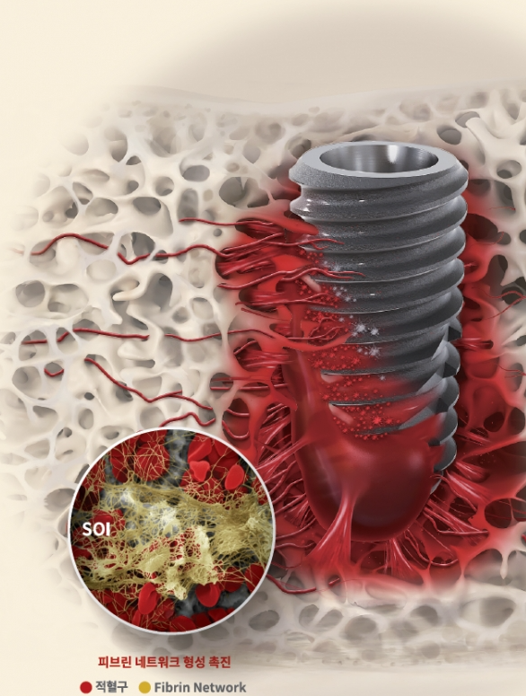 임플란트구조, 의사가 알려주는 2가지 핵심 구성요소 관련 이미지 6