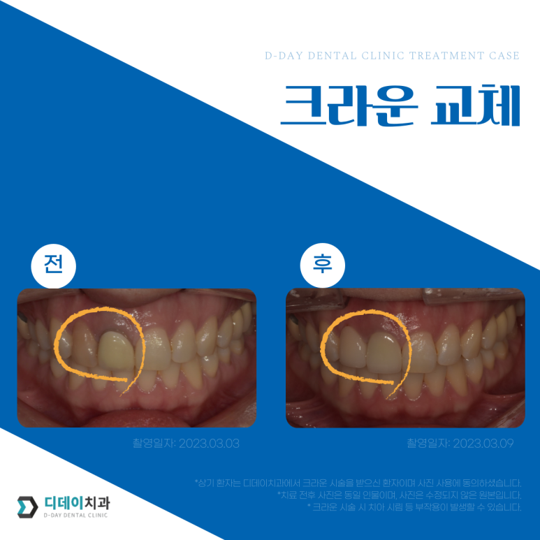 앞니크라운, 라미네이트 같이 하면 티날까? 사진으로 증명합니다. 관련 이미지 7