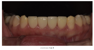 라미네이트유지기간, 절반도 못 쓰고 후회하는 환자들의 공통점 관련 이미지 8