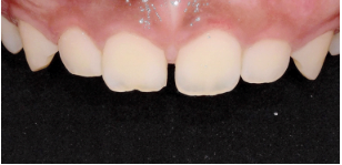 연예인잇몸성형? 시술 전 확인하세요. 관련 이미지 3