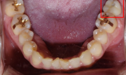 임플란트후붓기? 걱정하시던 환자분 치료 과정 관련 이미지 5