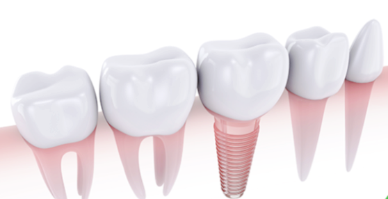 임플란트보증기간? 전문의가 설명드립니다. 관련 이미지 3
