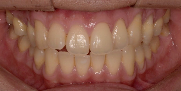 남자라미네이트, 최신 치료사례와 비용까지 전부 공개합니다. 관련 이미지 13