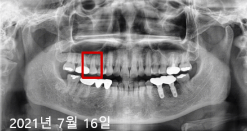 네비게이션인플란트가격? 이 글로 종결합니다. 관련 이미지 2