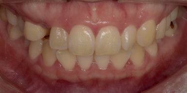 치아성형, 앞니 모양 획기적으로 바꾸는 방법이 있다? 관련 이미지 12