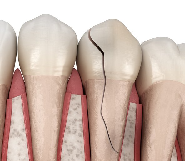 역삼동 크라운 치과 치료 필요한 치아상태, 꼭 확인하세요. 관련 이미지 3
