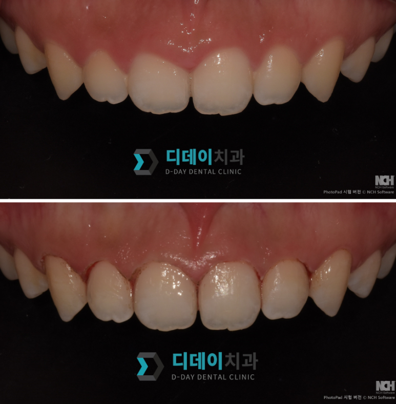 잇몸성형비용, 싸다고 바로 예약하면 안 되는 이유 관련 이미지 3