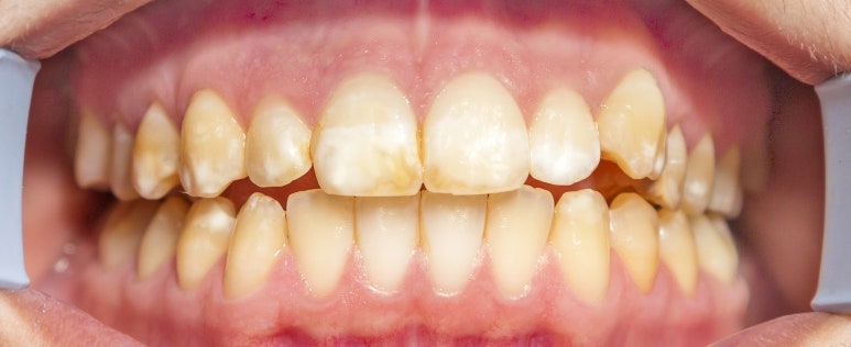 반상치 라미네이트 치료? 얼룩덜룩한 반점이 고민이면 보세요. 관련 이미지 1