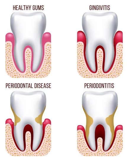 잇몸 부으면 치석 때문? 치아 흔들림의 이유 관련 이미지 5