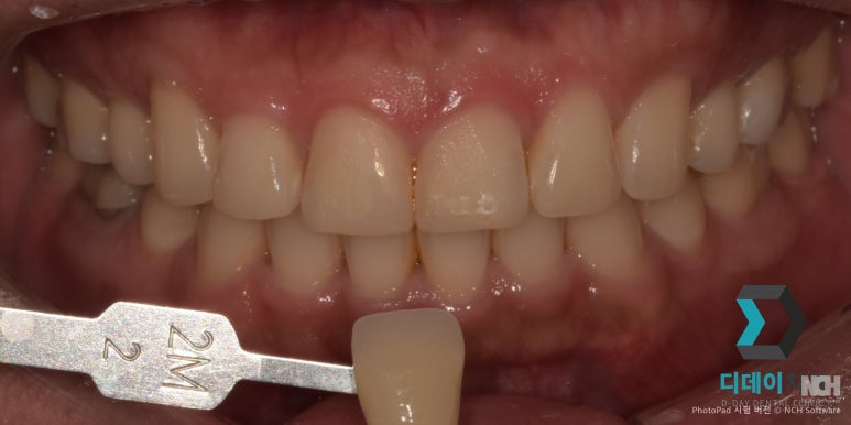 선릉역치아미백후기 보기 전에 관련 이미지 7