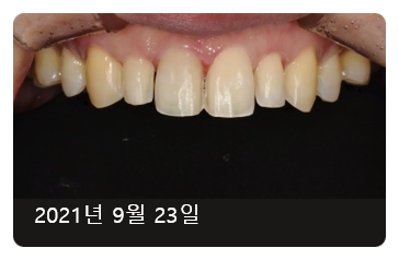 라미네이트치아삭제? "2년간 고민"하셨던 환자분 사례 관련 이미지 2