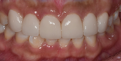 반상치 라미네이트 치료? 얼룩덜룩한 반점이 고민이면 보세요. 관련 이미지 3