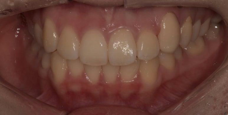 덧니교정만 된다? 라미네이트로도 덧니 치료 가능합니다. 관련 이미지 9