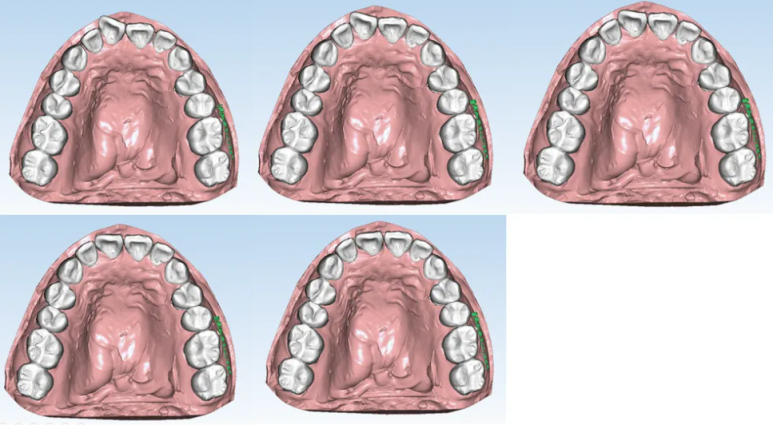 선릉 투명교정 시작 전, 반드시 확인할 체크리스트 관련 이미지 2