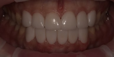 치아성형, 앞니 모양 획기적으로 바꾸는 방법이 있다? 관련 이미지 7