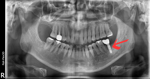 국산임플란트를 선택한 이유, 치료사례 공개합니다 관련 이미지 4