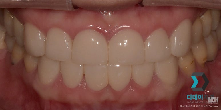 앞니살짝깨짐 이 1가지만 확인하면 치료 방향 결정됩니다 관련 이미지 8