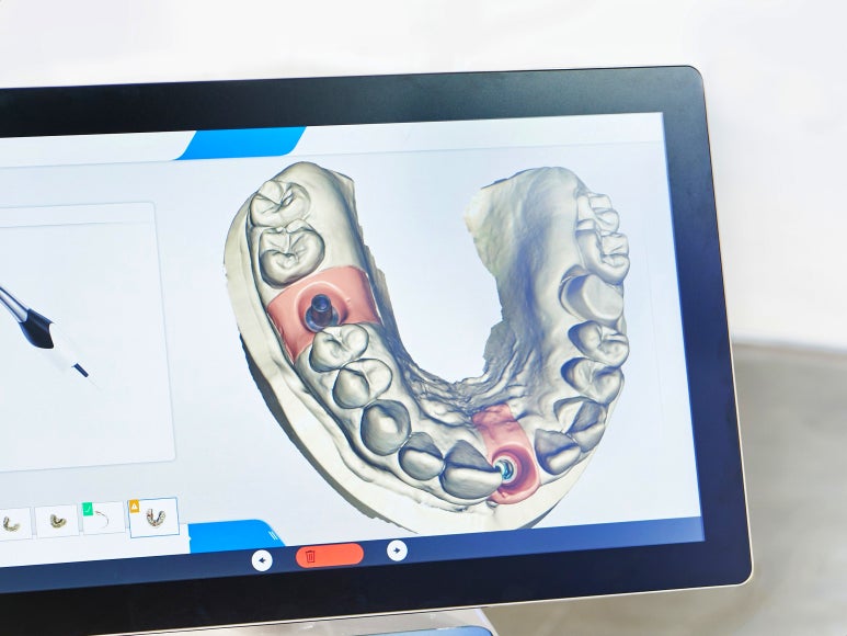 3D임플란트, 네비게이션 비용/통증/과정 총정리 관련 이미지 4